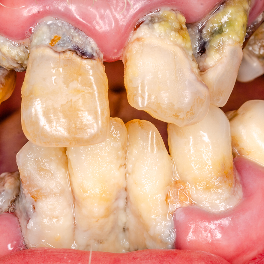 ボロボロの歯の総合治療